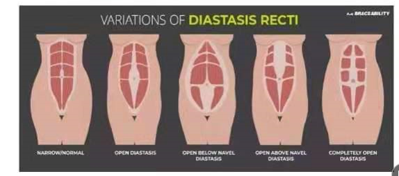 腹直肌分离如何分类？腹直肌分离修复