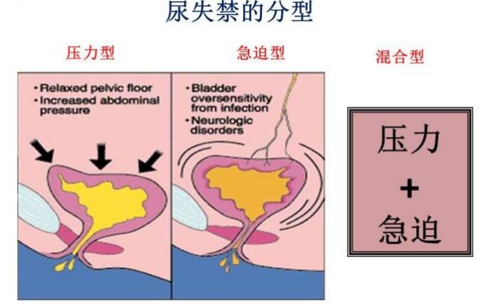 产后盆底肌怎么修复|尿失禁的类型，傻傻分不清