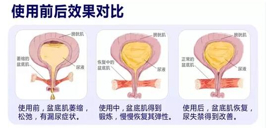 产后盆底肌怎么修复